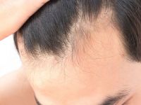 北京男士spa为什么头发总是油腻？
